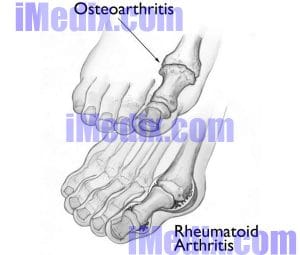 Osteoarthritis and rheumatoid arthritis
