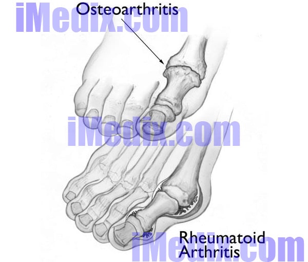 Osteoarthritis and rheumatoid arthritis